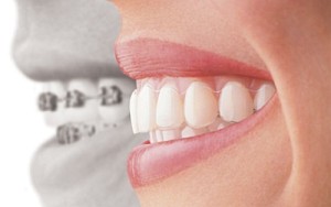 Orthodontie Den Haag, Orthodontist Den Haag, Orthodontie, Orthodontist